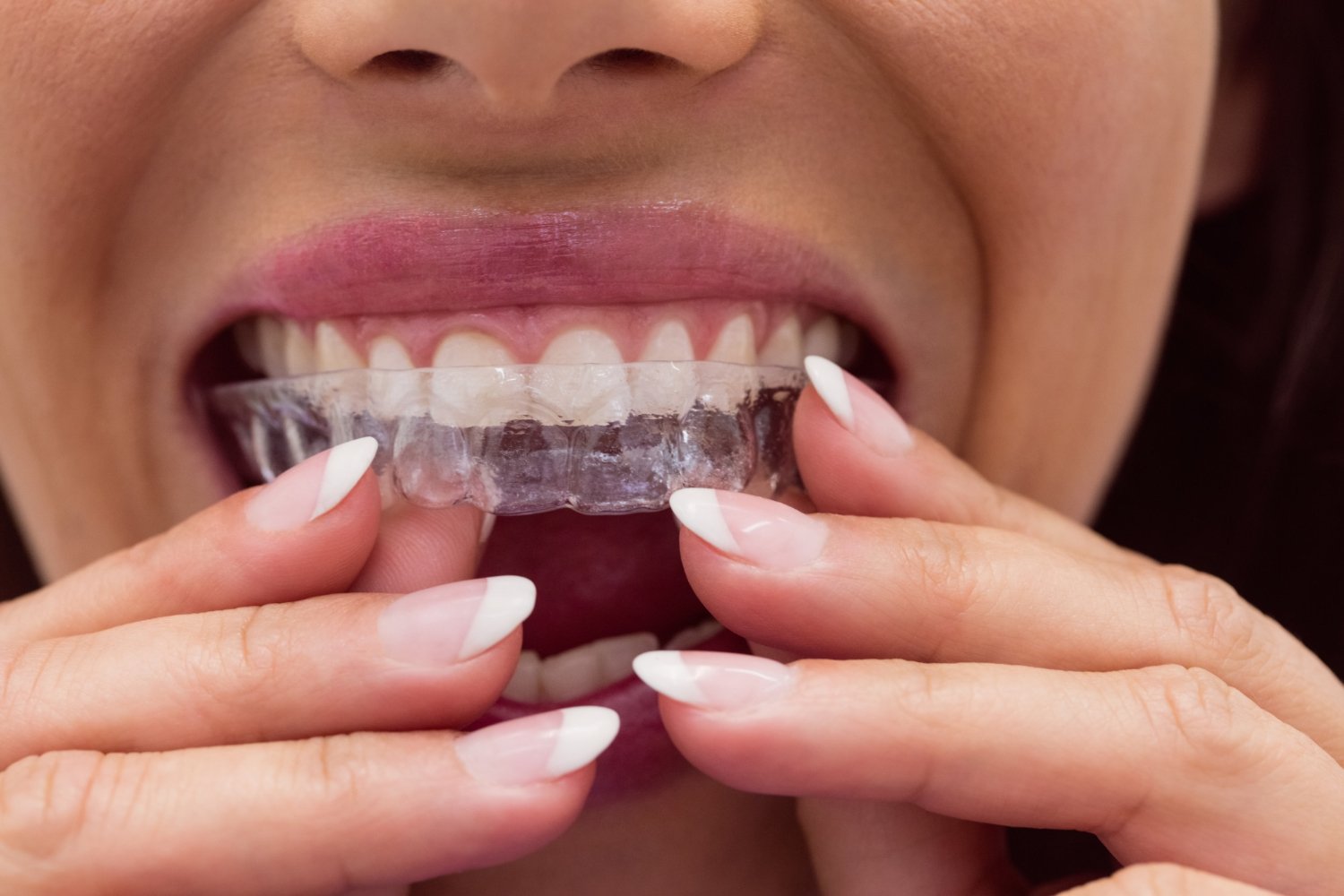 Clear Aligners vs Braces