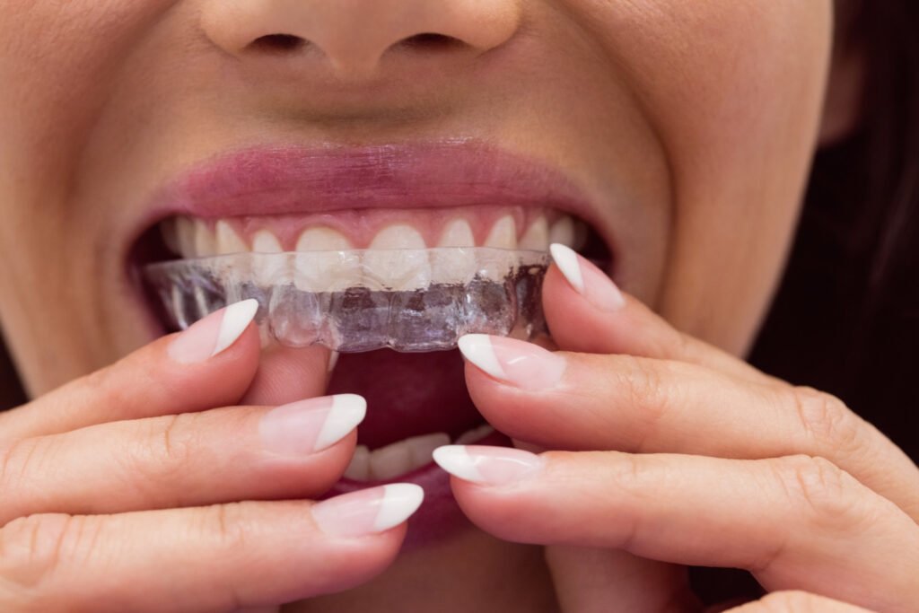Invisalign for Teens in Lagos